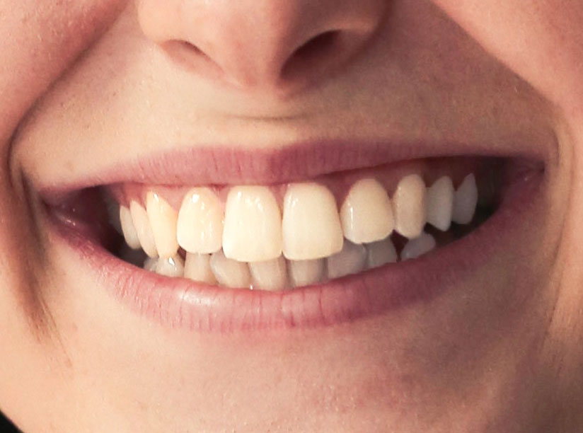 Tipa-denti-bianchi